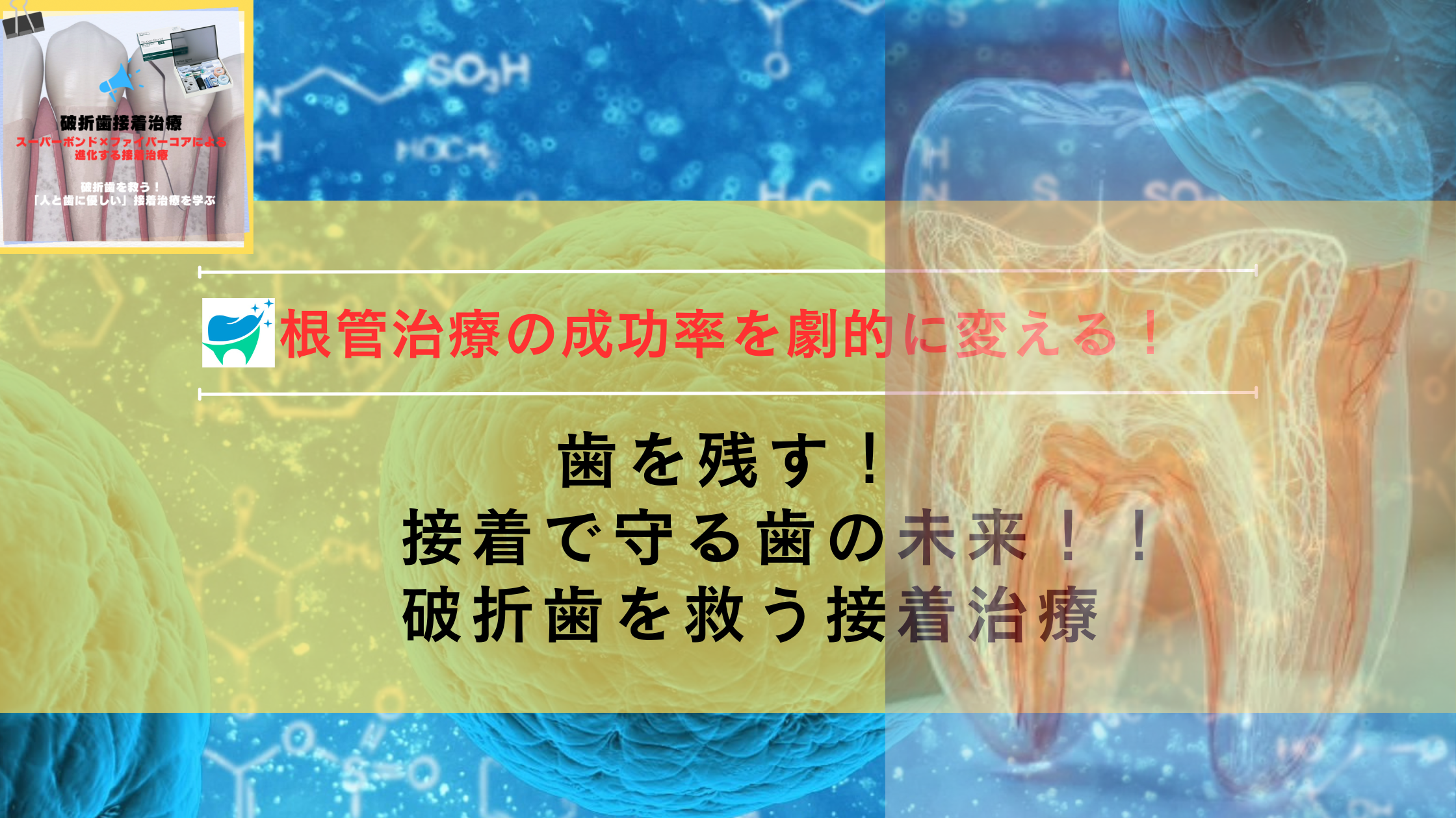 抜歯を回避せよ！！口腔内接着による破折歯の再生戦略：破折歯に対して